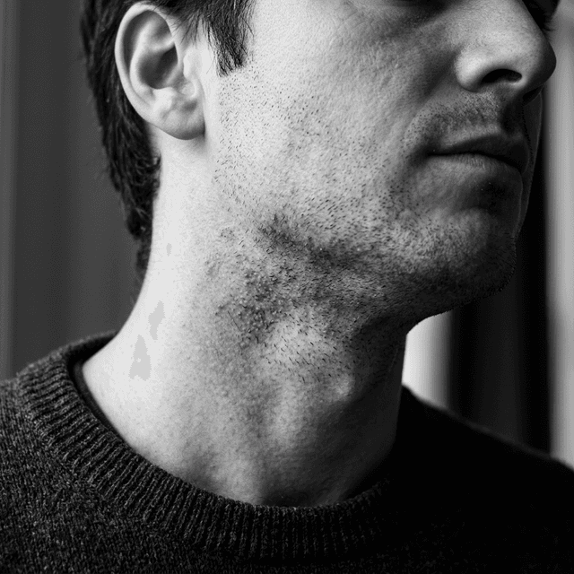 Post-Shave Irritation